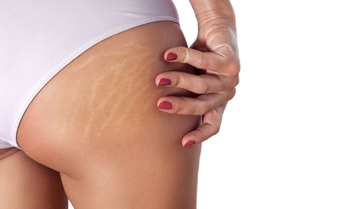 Tolk Enkelhed jorden Does Spray Tan Cover Stretch Marks? - Good Looking Tan